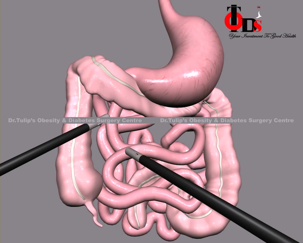  Ileal Interposition Surgery